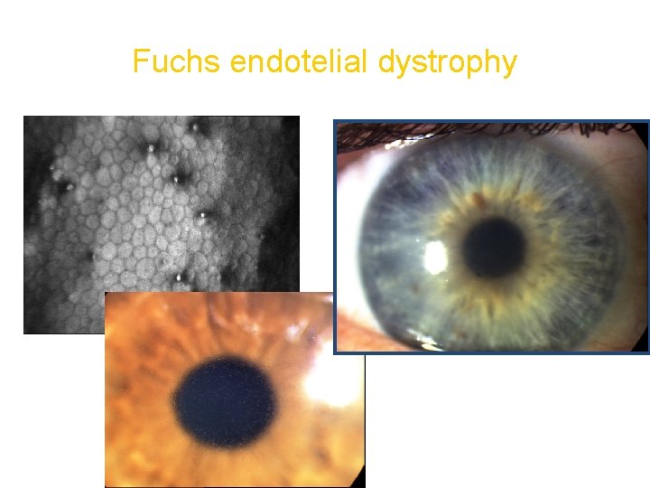 Fuchs endotelial dystrophy 