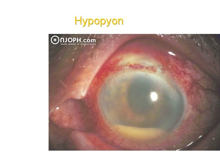 Hypopyon 