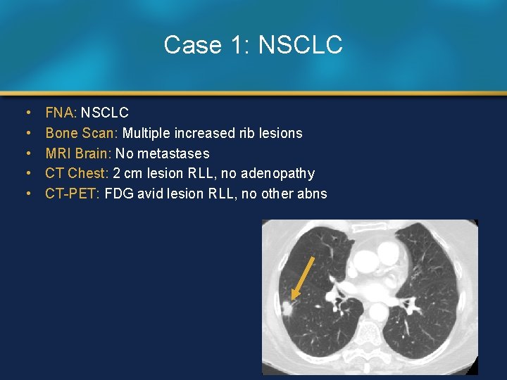 Case 1: NSCLC • • • FNA: NSCLC Bone Scan: Multiple increased rib lesions