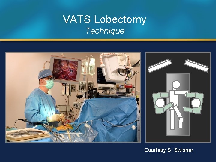 VATS Lobectomy Technique Courtesy S. Swisher 