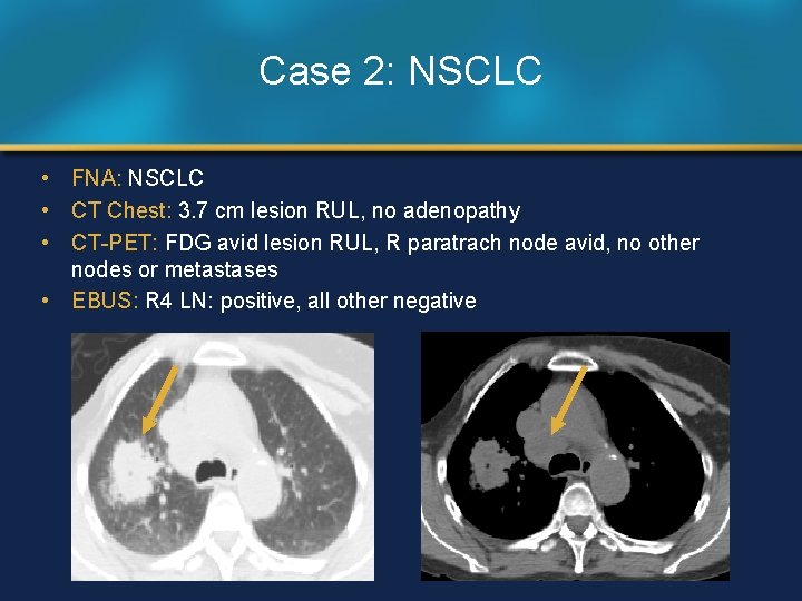 Case 2: NSCLC • FNA: NSCLC • CT Chest: 3. 7 cm lesion RUL,