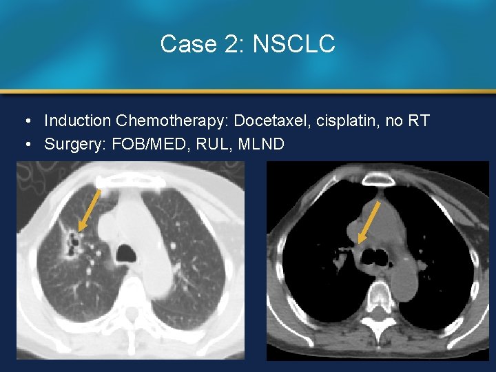 Case 2: NSCLC • Induction Chemotherapy: Docetaxel, cisplatin, no RT • Surgery: FOB/MED, RUL,
