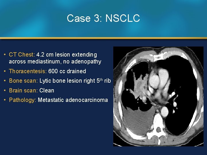 Case 3: NSCLC • CT Chest: 4. 2 cm lesion extending across mediastinum, no