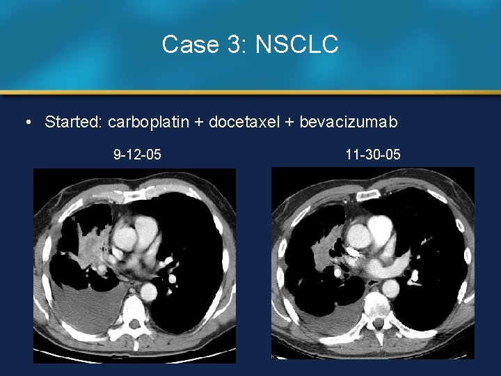 Case 3: NSCLC • Started: carboplatin + docetaxel + bevacizumab 9 -12 -05 11