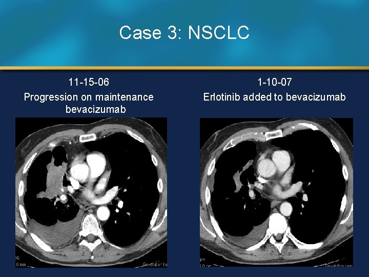 Case 3: NSCLC 11 -15 -06 Progression on maintenance bevacizumab 1 -10 -07 Erlotinib