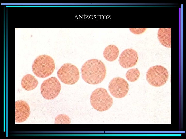 ANİZOSİTOZ 