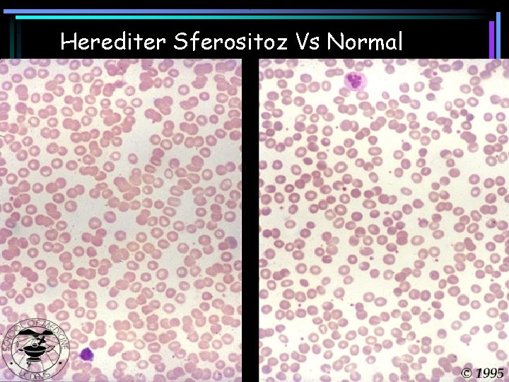 Herediter Sferositoz Vs Normal 