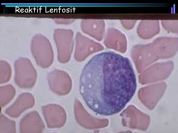 Reaktif Lenfosit 