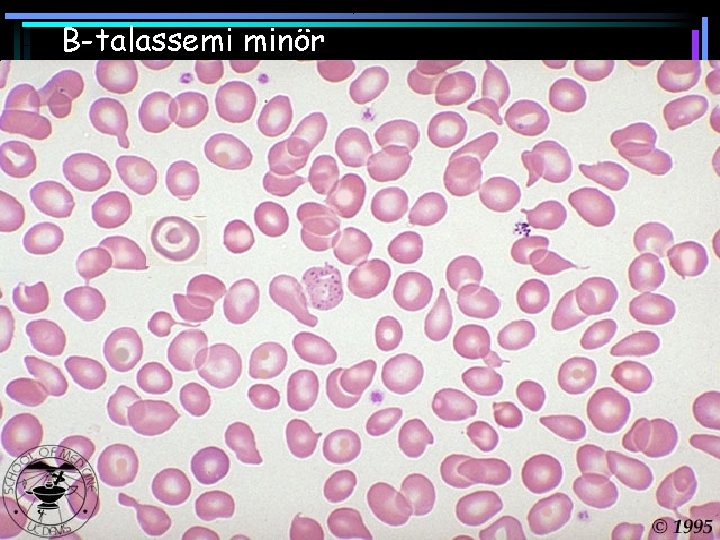 Β-talassemi minör 