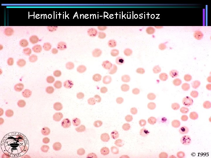Hemolitik Anemi-Retikülositoz 
