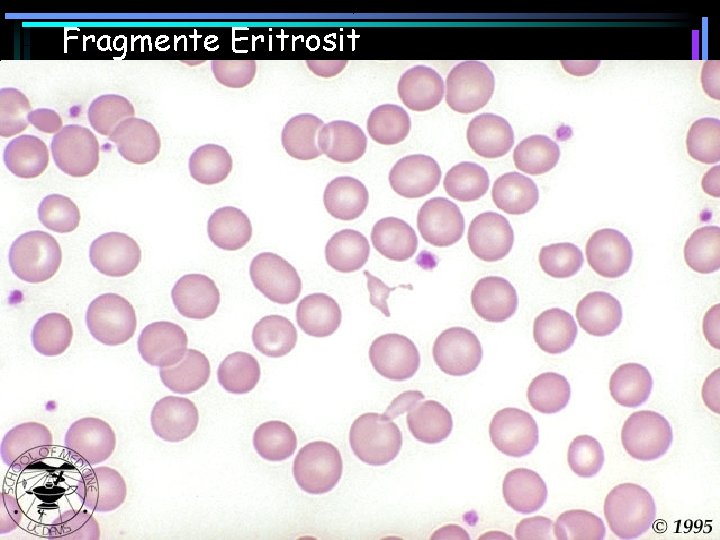 Fragmente Eritrosit 