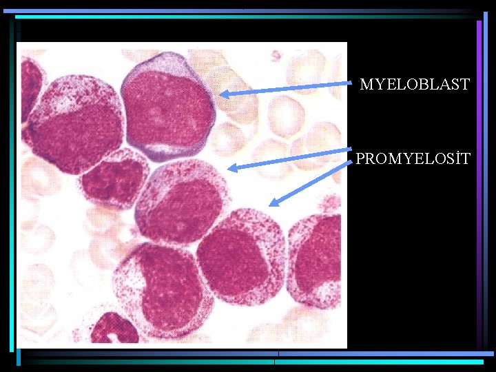 MYELOBLAST PROMYELOSİT 