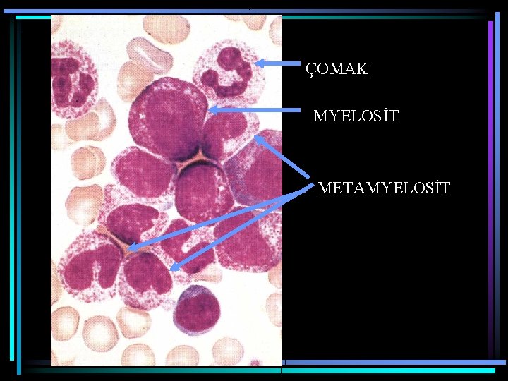 ÇOMAK MYELOSİT METAMYELOSİT 