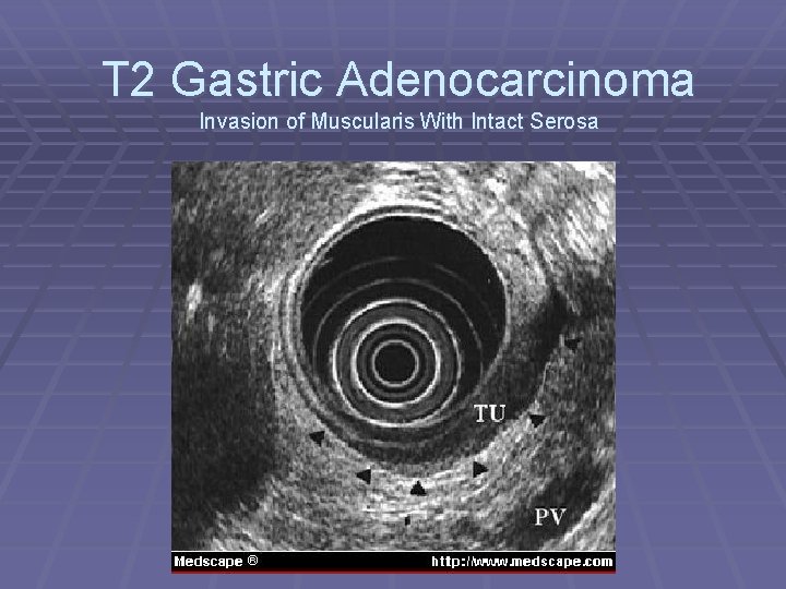 T 2 Gastric Adenocarcinoma Invasion of Muscularis With Intact Serosa 