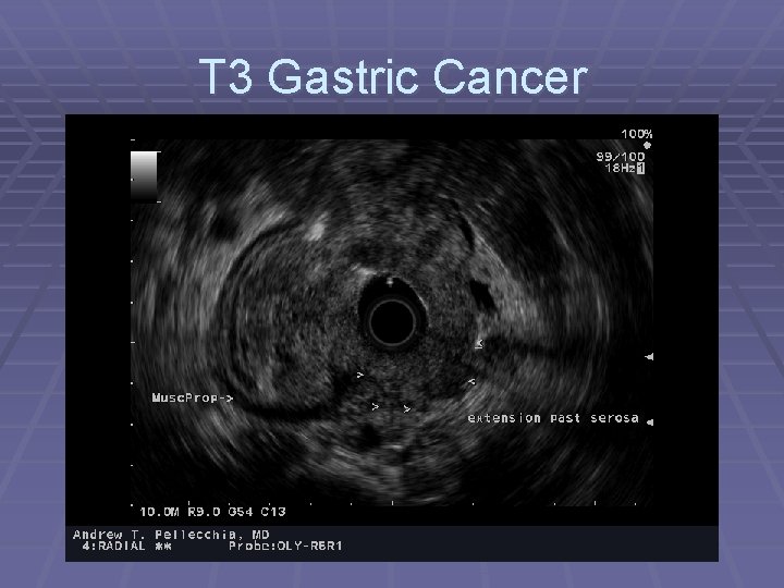 T 3 Gastric Cancer 