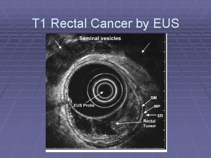 T 1 Rectal Cancer by EUS 