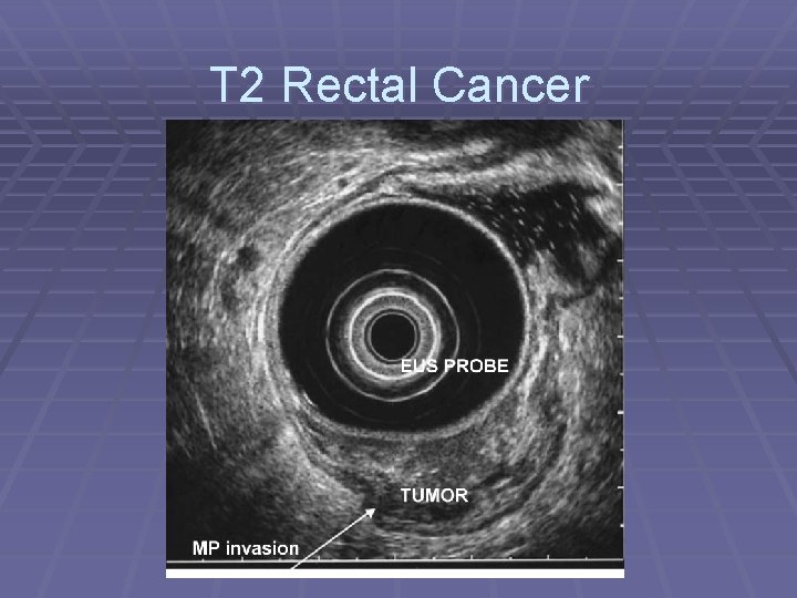 T 2 Rectal Cancer 