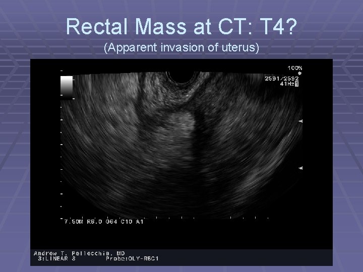 Rectal Mass at CT: T 4? (Apparent invasion of uterus) 