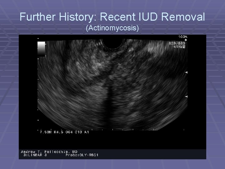 Further History: Recent IUD Removal (Actinomycosis) 