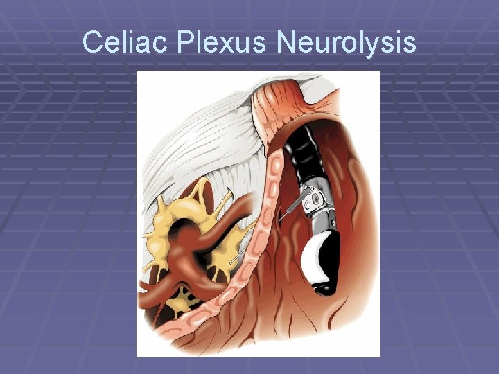 Celiac Plexus Neurolysis 