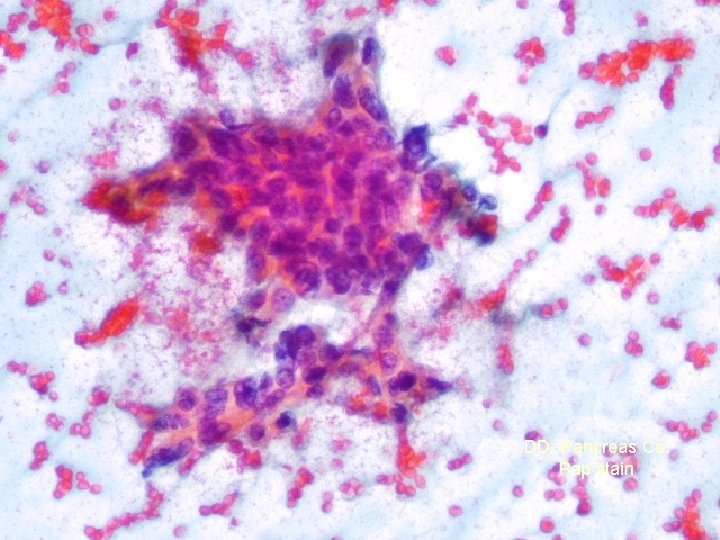 DD- Pancreas Ca. Pap stain 