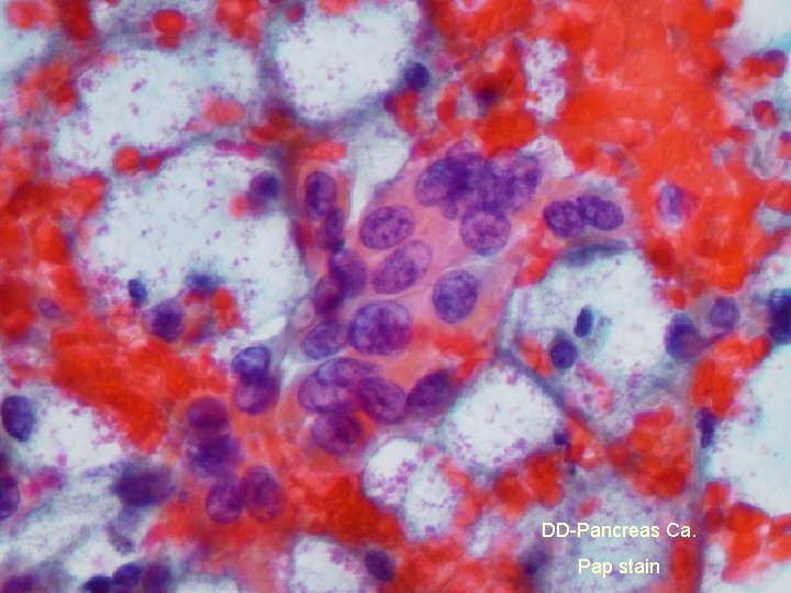 DD-Pancreas Ca. Pap stain 