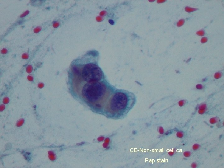 CE-Non-small cell ca. Pap stain 