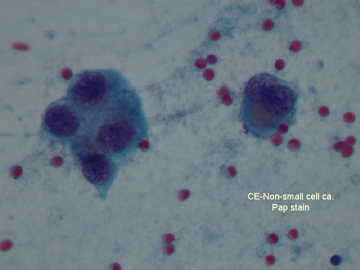 CE-Non-small cell ca. Pap stain 