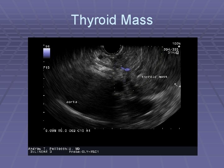 Thyroid Mass 