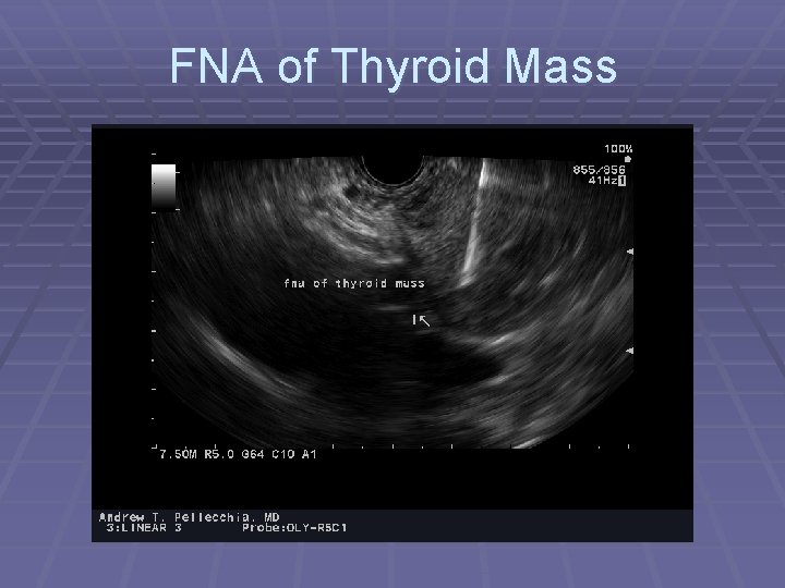 FNA of Thyroid Mass 
