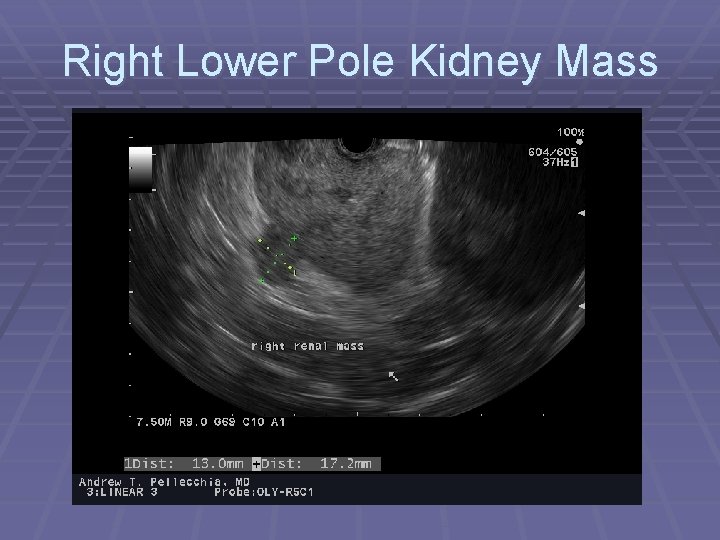 Right Lower Pole Kidney Mass 