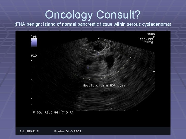 Oncology Consult? (FNA benign: Island of normal pancreatic tissue within serous cystadenoma) 