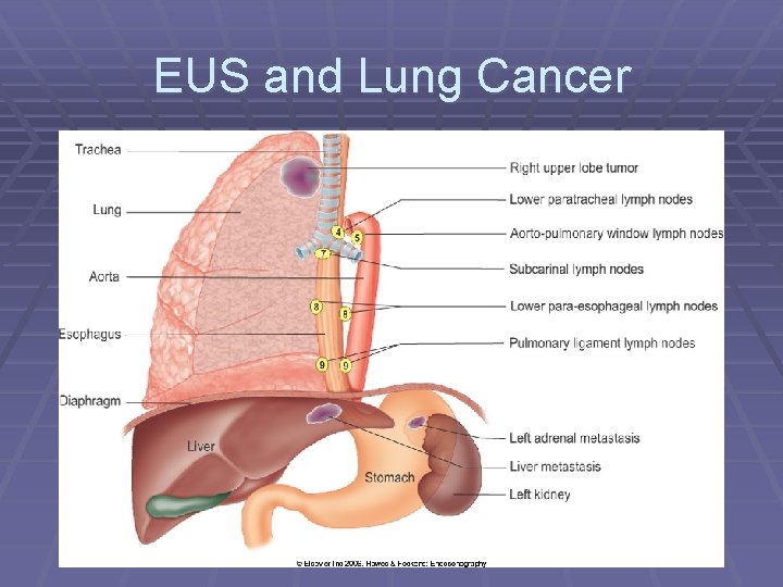 EUS and Lung Cancer 