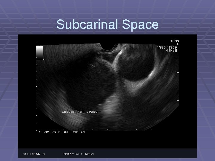 Subcarinal Space 