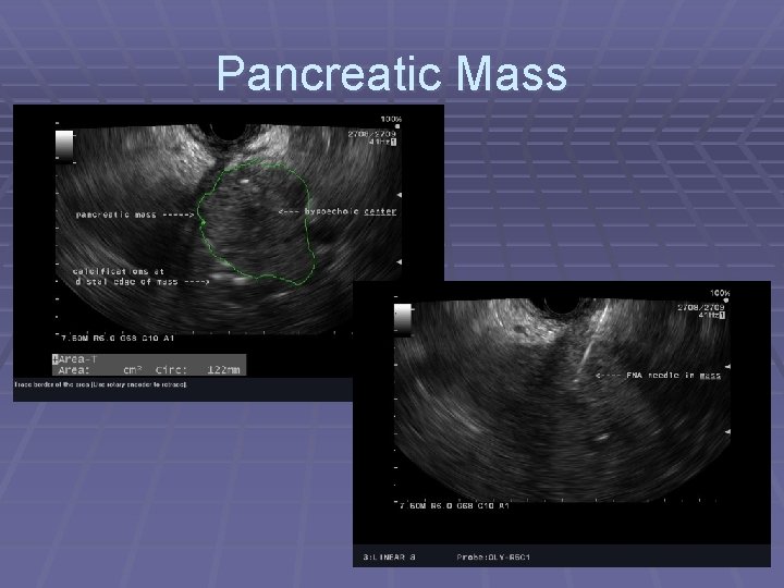 Pancreatic Mass 