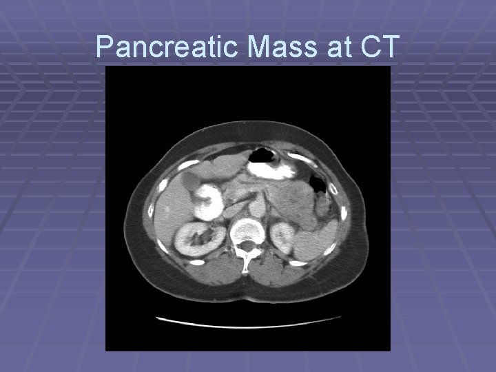 Pancreatic Mass at CT 