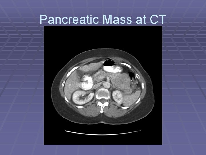 Pancreatic Mass at CT 