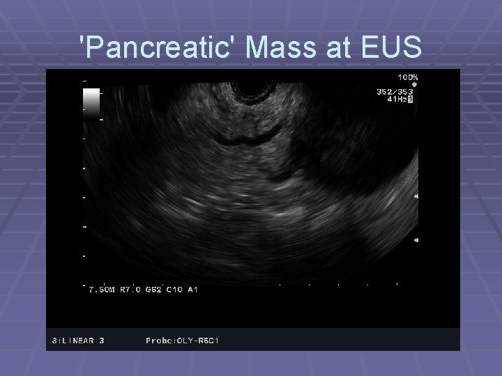 'Pancreatic' Mass at EUS 