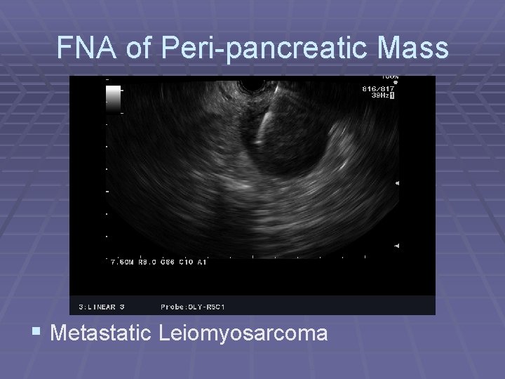 FNA of Peri-pancreatic Mass § Metastatic Leiomyosarcoma 