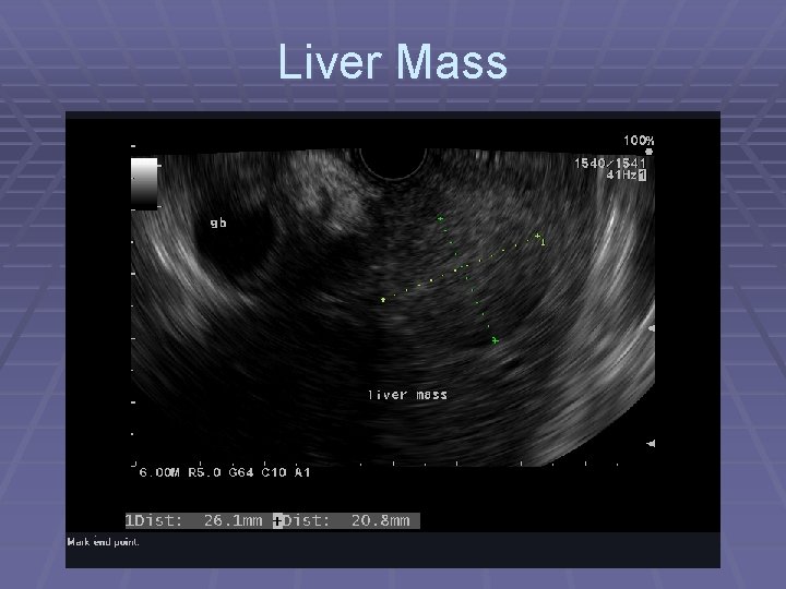 Liver Mass 