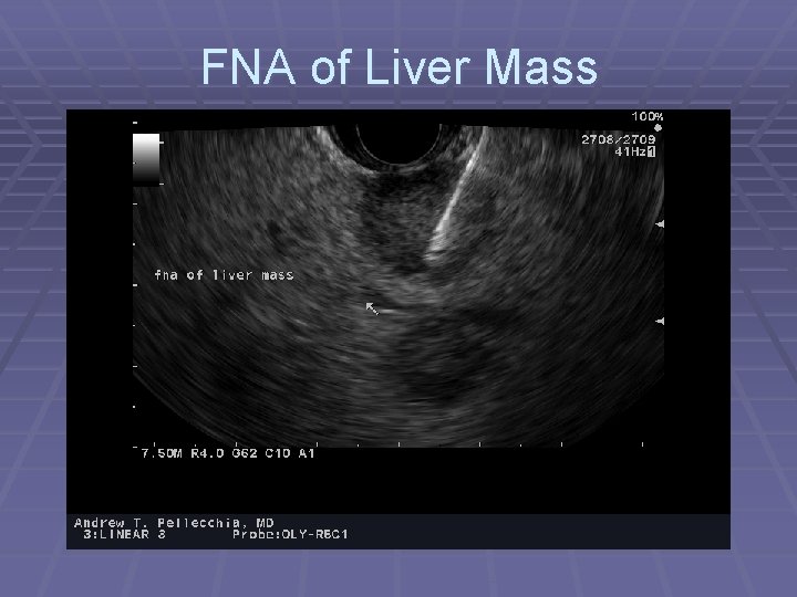 FNA of Liver Mass 
