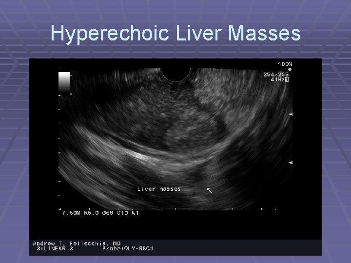 Hyperechoic Liver Masses 