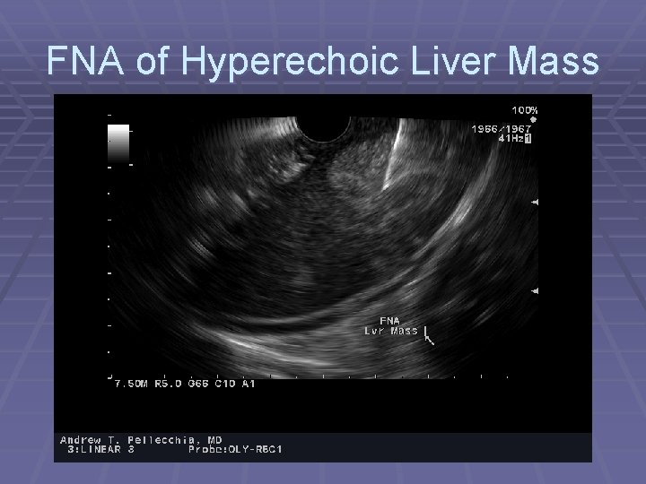 FNA of Hyperechoic Liver Mass 