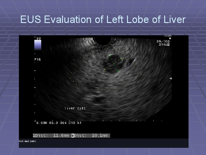 EUS Evaluation of Left Lobe of Liver 