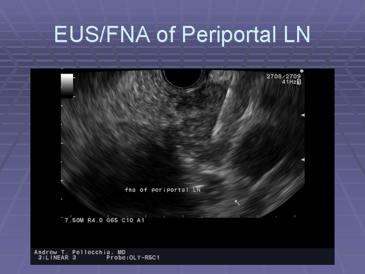 EUS/FNA of Periportal LN 