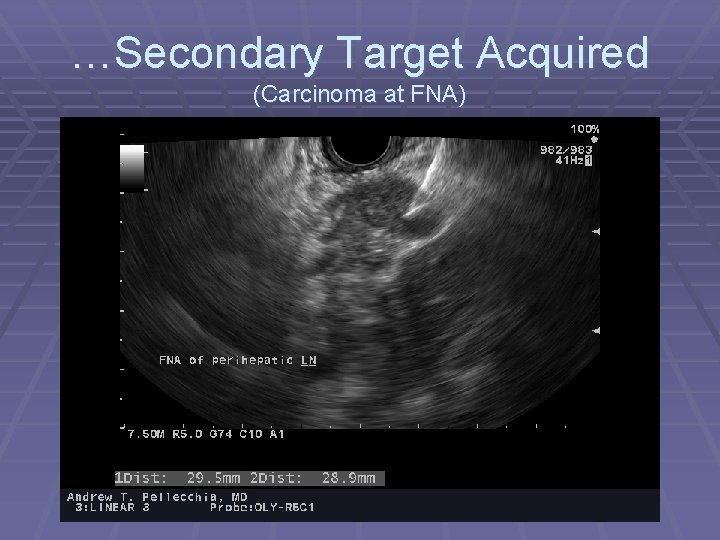 …Secondary Target Acquired (Carcinoma at FNA) 