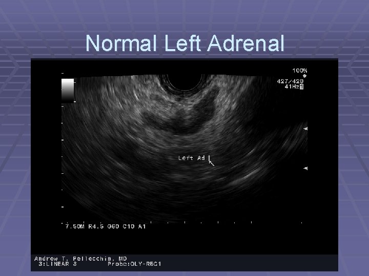 Normal Left Adrenal 