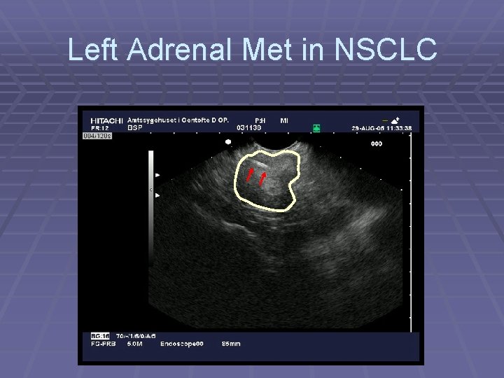 Left Adrenal Met in NSCLC 