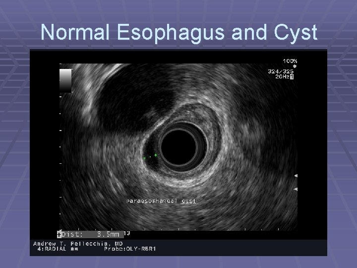 Normal Esophagus and Cyst 