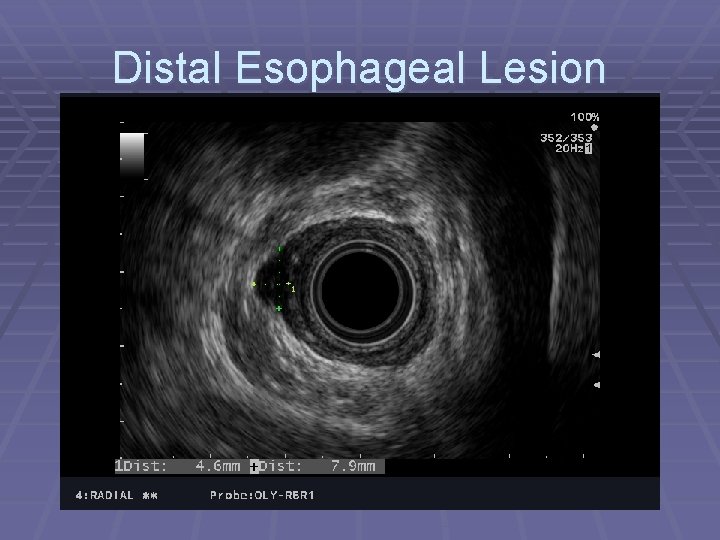 Distal Esophageal Lesion 